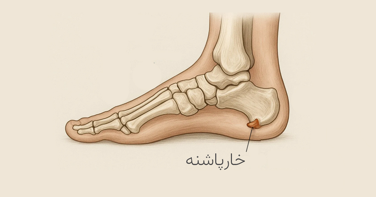 درمان خارپاشنه کفی طبی اسکن کف پا ارتوپدی کرج